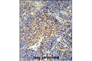 OTUD4 antibody (N-term) (ABIN652177 and ABIN2840579) immunohistochemistry analysis in formalin fixed and paraffin embedded human lung carcinoma followed by peroxidase conjugation of the secondary antibody and DAB staining. (OTUD4 Antikörper  (N-Term))