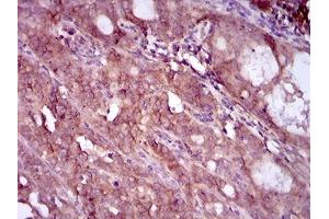 Immunohistochemical analysis of paraffin-embedded cervical cancer tissues using EGFR mutant mouse mAb with DAB staining. (EGFR Mutant (AA 693-893) Antikörper)