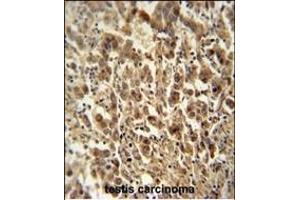 DIS3 antibody (Center) (ABIN654155 and ABIN2844022) immunohistochemistry analysis in formalin fixed and paraffin embedded human testis carcinoma followed by peroxidase conjugation of the secondary antibody and DAB staining. (DIS3 Antikörper  (AA 295-323))