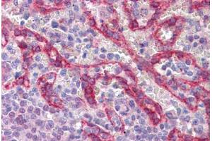 Immunohistochemistry (Formalin-fixed Paraffin-embedded Sections) (IHC (fp)) image for anti-Cadherin 1, Type 1, E-Cadherin (Epithelial) (CDH1) (AA 381-481) antibody (ABIN574222)