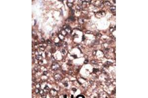 Formalin-fixed and paraffin-embedded human cancer tissue reacted with the primary antibody, which was peroxidase-conjugated to the secondary antibody, followed by DAB staining. (LRP8 Antikörper  (C-Term))