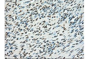Immunohistochemical staining of paraffin-embedded Adenocarcinoma of breast tissue using anti-TYRO3 mouse monoclonal antibody. (TYRO3 Antikörper)