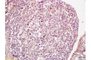 Formalin-fixed and paraffin embedded human lung carcinoma labeled with Anti-P53(wt-p53) Polyclonal Antibody, Unconjugated (ABIN677408) at 1:200 followed by conjugation to the secondary antibody and DAB staining. (p53 Antikörper  (AA 301-393))