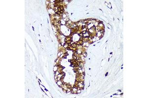 Immunohistochemistry of paraffin-embedded Human breast cancer using HSD17B7 Rabbit pAb (ABIN7267812) at dilution of 1:100 (40x lens). (HSD17B7 Antikörper  (AA 110-200))