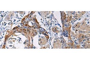 Immunohistochemistry of paraffin-embedded Human esophagus cancer tissue using RITA1 Polyclonal Antibody at dilution of 1:60(x200) (RITA1 Antikörper)