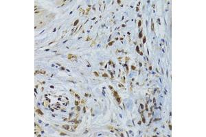 Immunohistochemistry of paraffin-embedded human gastric cancer using GABPB1 Antibody (ABIN2562720) at dilution of 1:100 (40x lens). (GABPB1 Antikörper)