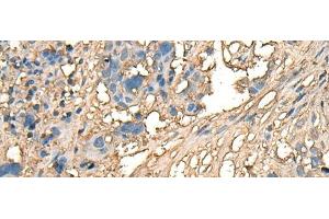 Immunohistochemistry of paraffin-embedded Human lung cancer tissue using CELA1 Polyclonal Antibody at dilution of 1:70(x200)