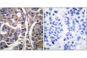 Immunohistochemistry analysis of paraffin-embedded human breast carcinoma tissue, using Keratin 20 Antibody. (KRT20 Antikörper  (AA 375-424))