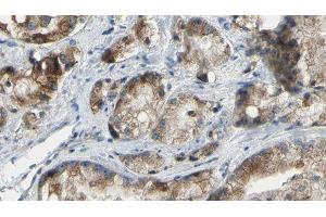 ABIN6277337 at 1/100 staining Human prostate tissue by IHC-P. (PAK4 Antikörper  (Internal Region))