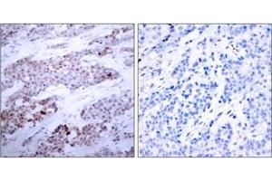 Immunohistochemistry analysis of paraffin-embedded human breast carcinoma, using ATF4 (Phospho-Ser245) Antibody. (ATF4 Antikörper  (pSer245))