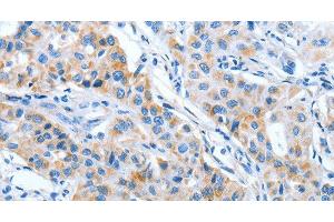Immunohistochemistry of paraffin-embedded Human lung cancer using IMMT Polyclonal Antibody at dilution of 1:70 (IMMT Antikörper)