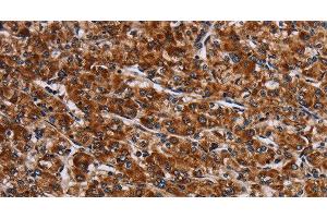 Immunohistochemistry of paraffin-embedded Human prostate cancer tissue using LRRC15 Polyclonal Antibody at dilution 1:60 (LRRC15 Antikörper)