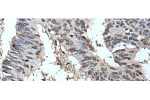 Immunohistochemistry of paraffin-embedded Human colorectal cancer tissue using HELLS Polyclonal Antibody at dilution of 1:30(x200) (HELLS Antikörper)