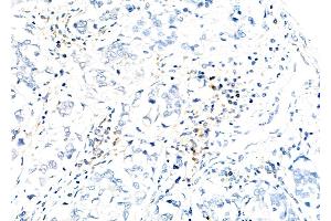 ABIN6260295 and ABIN6279783 at 1/100 staining Human liver cancer by IHC-P. (BMS1 Antikörper  (C-Term))