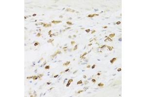 Immunohistochemistry of paraffin-embedded human gastric cancer using LSP1 Antibody (ABIN5973271) at dilution of 1/100 (40x lens). (LSP1 Antikörper)