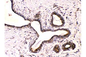 Beta III Tubulin was detected in paraffin-embedded sections of human mammary cancer tissues using rabbit anti- Beta III Tubulin Antigen Affinity purified polyclonal antibody (Catalog # ) at 1 µg/mL. (TUBB3 Antikörper  (C-Term))