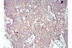 Immunohistochemical analysis of paraffin-embedded bladder cancer tissues using NOX4 mouse mAb with DAB staining. (NADPH Oxidase 4 Antikörper  (AA 210-310))