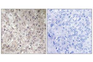 Immunohistochemistry analysis of paraffin-embedded human liver carcinoma tissue using GIPR antibody. (GIPR Antikörper  (Internal Region))