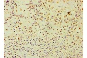 Immunohistochemistry of paraffin-embedded human breast cancer using ABIN7144295 at dilution of 1:100 (ANXA8L2 Antikörper  (AA 1-276))
