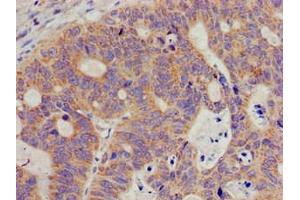 Immunohistochemistry of paraffin-embedded human colon cancer using ABIN7169599 at dilution of 1:100 (SIGMAR1 Antikörper  (AA 112-169))