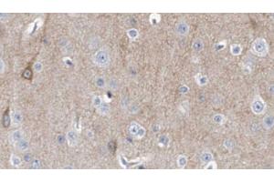 ABIN6278328 at 1/100 staining Human brain cancer tissue by IHC-P. (DCTN3 Antikörper  (N-Term))