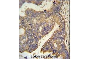 PAR6G Antibody IHC analysis in formalin fixed and paraffin embedded human colon carcinoma followed by peroxidase conjugation of the secondary antibody and DAB staining. (PARD6G Antikörper  (N-Term))