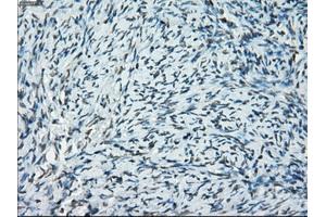 Immunohistochemical staining of paraffin-embedded Adenocarcinoma of breast tissue using anti-PRKY mouse monoclonal antibody. (PRKY Antikörper)