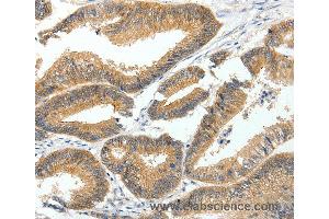 Immunohistochemistry of Human lung cancer using MDK Polyclonal Antibody at dilution of 1:60 (Midkine Antikörper)