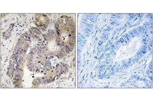 Immunohistochemistry analysis of paraffin-embedded human colon carcinoma, using CAD (Phospho-Thr456) Antibody. (CAD Antikörper  (pThr456))