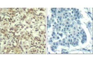 Immunohistochemical analysis of paraffin-embedded human breast carcinoma tissue using AKT1 (phospho- Thr450) Antibody (E011502). (AKT1 Antikörper  (pThr450))