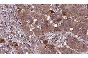 ABIN6277679 at 1/100 staining Human liver cancer tissue by IHC-P. (Serotonin Receptor 3A Antikörper  (Internal Region))