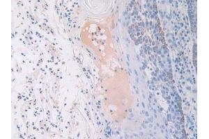 Detection of FGFR3 in Human Skin cancer Tissue using Polyclonal Antibody to Fibroblast Growth Factor Receptor 3 (FGFR3) (FGFR3 Antikörper  (AA 166-375))