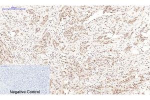 Immunohistochemical analysis of paraffin-embedded human breast cancer tissue.