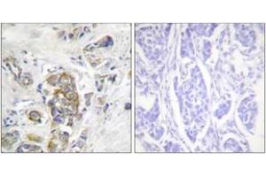 Immunohistochemistry analysis of paraffin-embedded human breast carcinoma, using ITGB4 (Phospho-Tyr1510) Antibody. (Integrin beta 4 Antikörper  (pTyr1510))