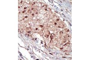 Formalin-fixed and paraffin-embedded human cancer tissue (hepatocarcinoma) reacted with the primary antibody, which was peroxidase-conjugated to the secondary antibody, followed by AEC staining. (SPHK1 Antikörper  (AA 286-315))