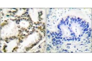 Immunohistochemistry analysis of paraffin-embedded human lung carcinoma tissue, using DJ-1 Antibody. (PARK7/DJ1 Antikörper  (AA 21-70))