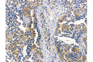 ABIN6257319 and ABIN6276046 at 1/100 staining Human lung cancer by IHC-P. (MC4R Antikörper  (C-Term))