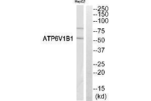 Immunohistochemistry analysis of paraffin-embedded human breast carcinoma tissue, using ATP6V1B1 antibody. (ATP6V1B1 Antikörper  (C-Term))