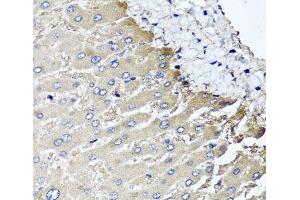 Immunohistochemistry of paraffin-embedded Human liver damage using MGAT1 Polyclonal Antibody at dilution of 1:100 (40x lens). (MGAT1 Antikörper)