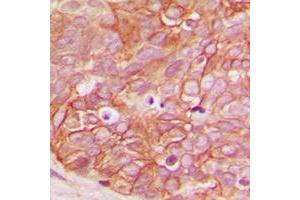 Immunohistochemical analysis of Beta-catenin (pS33) staining in human breast cancer formalin fixed paraffin embedded tissue section.