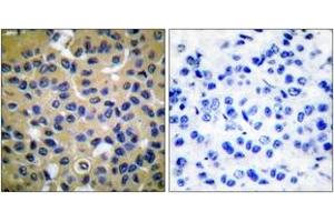 Immunohistochemistry analysis of paraffin-embedded human breast carcinoma tissue, using Collagen II Antibody.