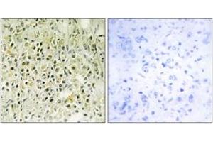 Immunohistochemistry analysis of paraffin-embedded human prostate carcinoma tissue, using LEG8 Antibody. (LGALS8 Antikörper  (AA 61-110))