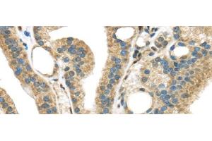 Immunohistochemistry of paraffin-embedded Human thyroid cancer tissue using STK35 Polyclonal Antibody at dilution 1:45 (STK35 Antikörper)