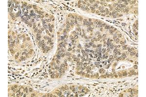 NUP50 Mouse Monoclonal Antibody at 1/100 staining human lung cancer and adjacent non-tumor tissue by IHC-P.