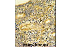 DPP8 Antibody IHC analysis in formalin fixed and paraffin embedded human Prostate carcinoma followed by peroxidase conjugation of the secondary antibody and DAB staining.