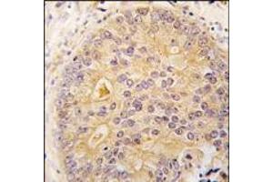 Formalin-fixed and paraffin-embedded human prostata carcinoma tissue reacted with CAMKK2 antibody (N-term), which was peroxidase-conjugated to the secondary antibody, followed by DAB staining. (CAMKK2 Antikörper  (N-Term))