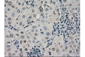 Immunohistochemical staining of paraffin-embedded Adenocarcinoma of ovary tissue using anti-CRYABmouse monoclonal antibody. (CRYAB Antikörper)