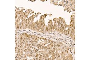 Immunohistochemistry of paraffin-embedded human colon carcinoma using [KO Validated]  Rabbit mAb (ABIN7271243) at dilution of 1:100 (40x lens). (AKT1 Antikörper)