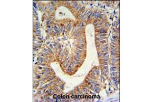 RPL17 Antibody IHC analysis in formalin fixed and paraffin embedded colon carcinoma followed by peroxidase conjugation of the secondary antibody and DAB staining. (RPL17 Antikörper  (C-Term))