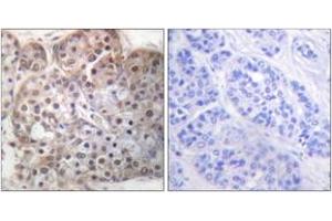 Immunohistochemistry analysis of paraffin-embedded human breast carcinoma, using STAT5A/B (Phospho-Ser725/730) Antibody. (STAT5 A/B Antikörper  (pSer726))